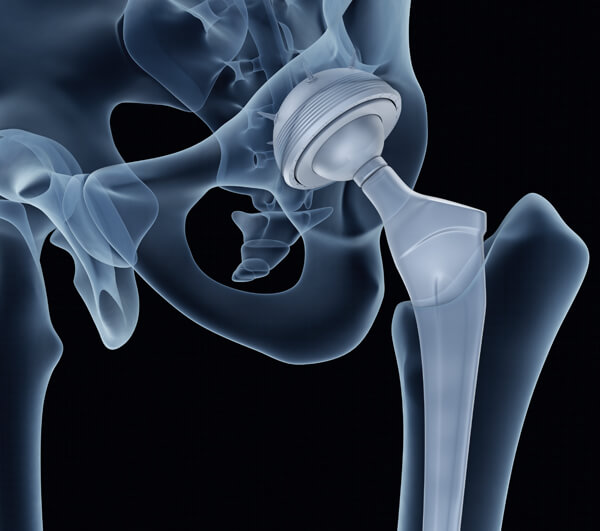 Artificial Joint